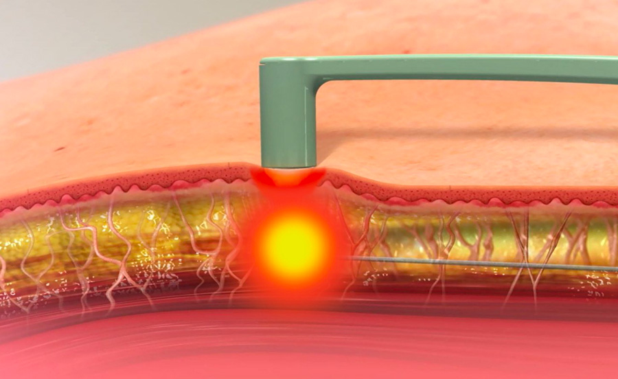 FACETITE, UNE TOUTE NOUVELLE TECHNIQUE DE RAJEUNISSEMENT NON CHIRURGICALE